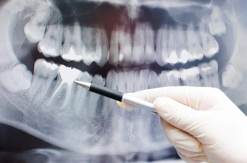 متخصص درمان ریشه دندان در تهران