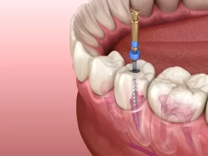 عصب کشی دندان چیست