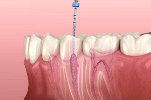 جراحی ریشه دندان چیست؟