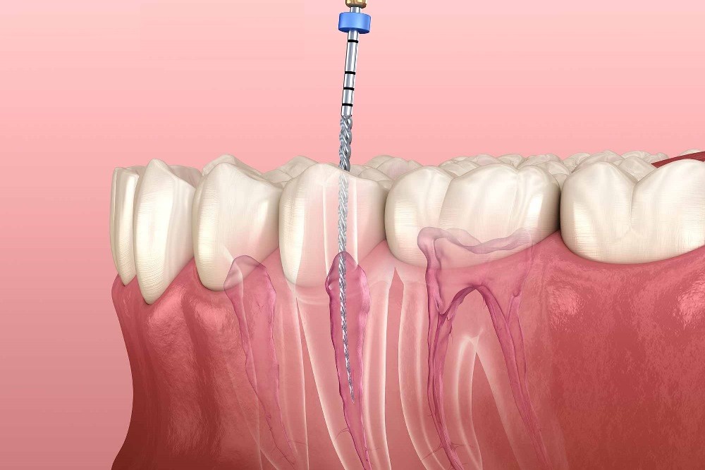 جراحی ریشه دندان چیست؟