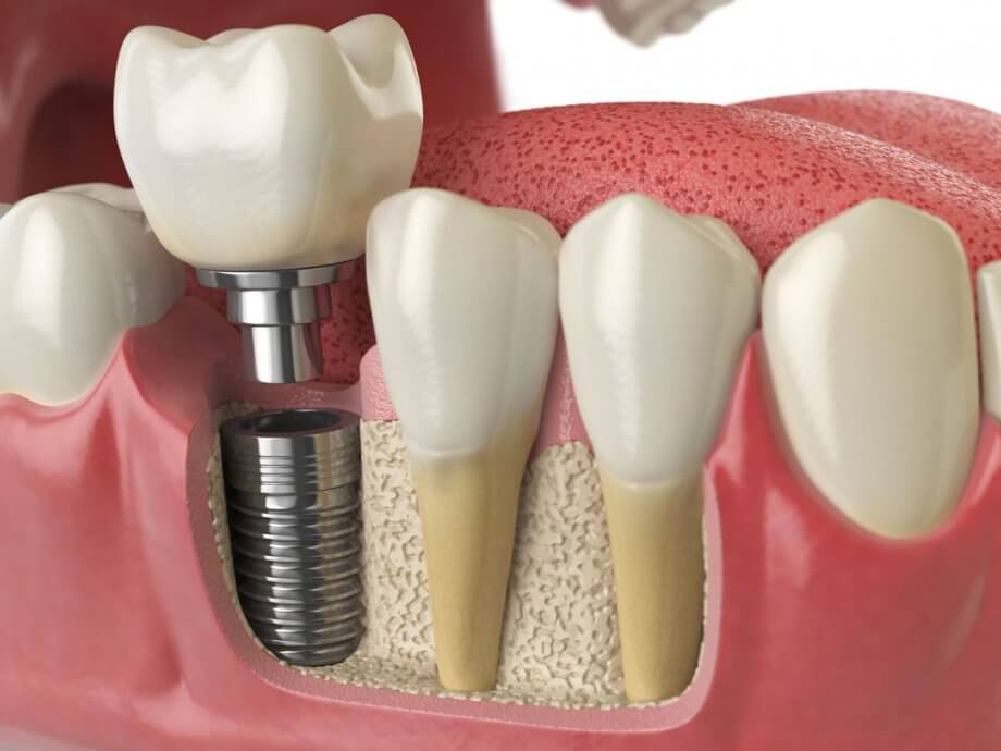 تعریفی از ایمپلنت دندان