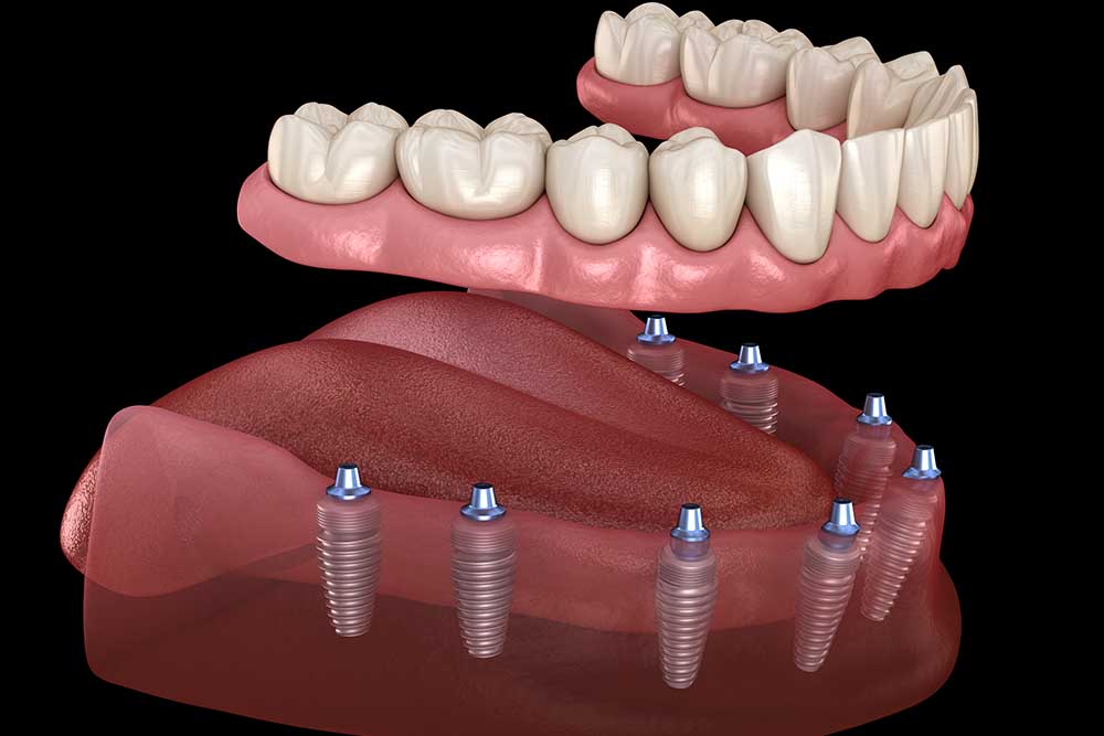 چگونگی انجام ایمپلنت دندان