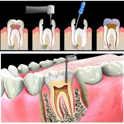 چرا باید دندان را عصب کشی کنیم؟