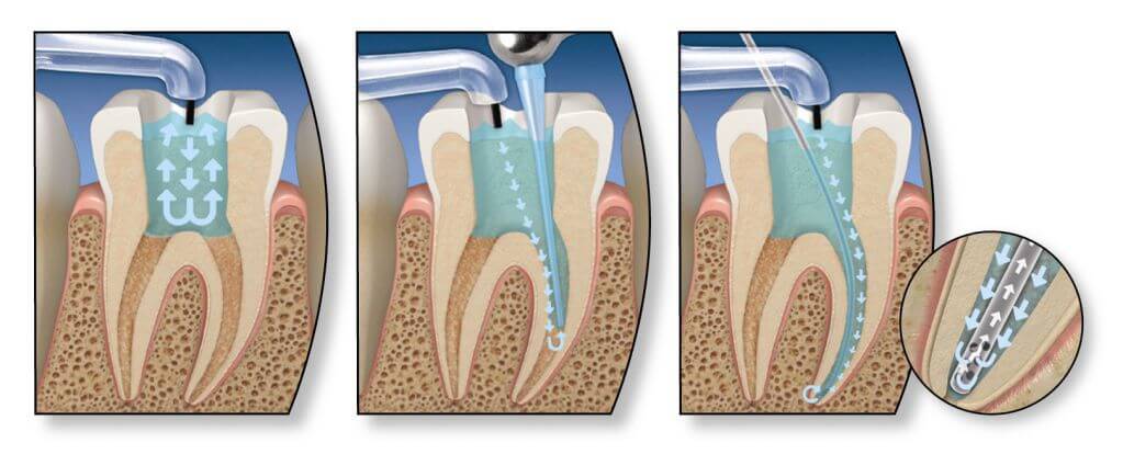 درمان ریشه دندان بدون عصب کشی