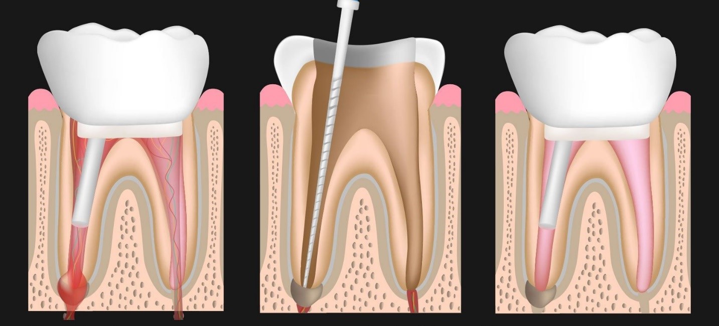 آشنایی با اجرای فرآیند عصب کشی دندان