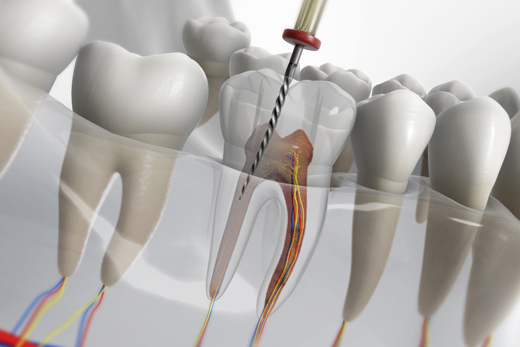 انواع روش های درمان ریشه دندان