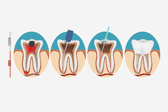 انواع روش‌های درمانی ریشه دندان