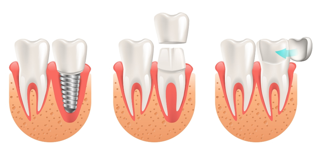 ایمپلنت دندان؛ مزایا و معایب