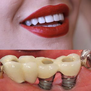 ایمپلنت دندان بهتر است یا روکش؟