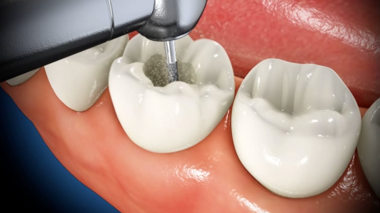 روش‌های جدید در درمان ریشه دندان