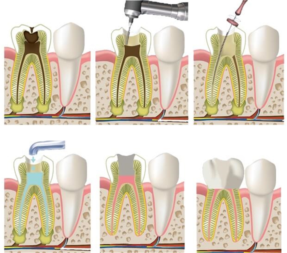 مزایای درمان ریشه دندان بدون عصب کشی