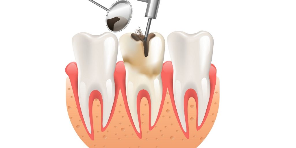علت‌ های عفونت ریشه دندان