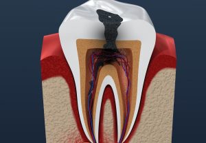 آیا ریشه دندان عفونی را بکشیم یا عصب کشی کنیم؟
