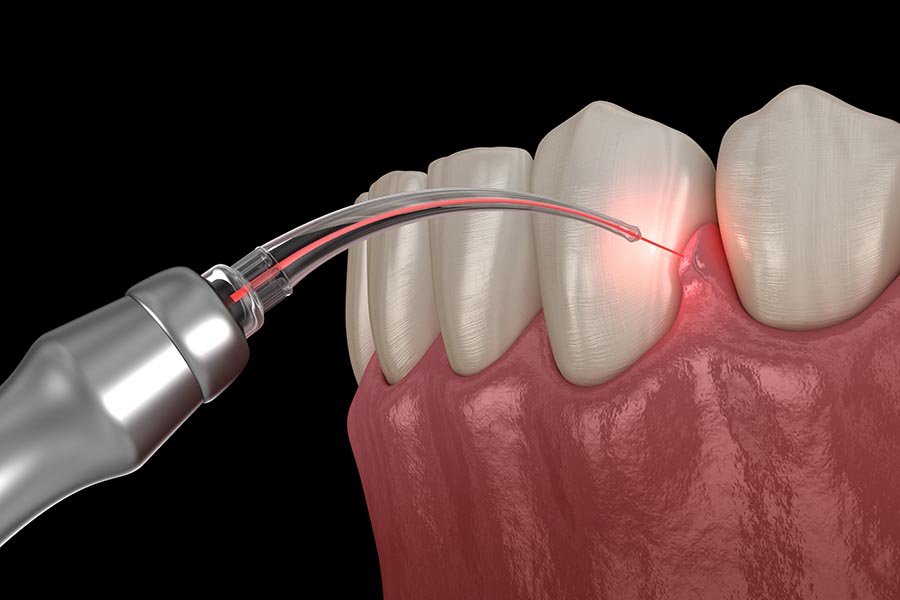 روش جدید درمان ریشه دندان