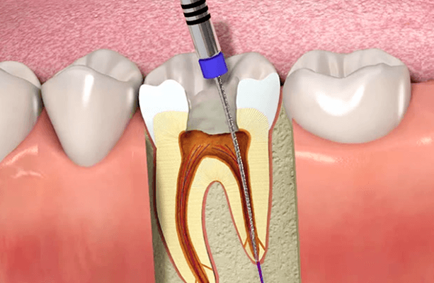 تکنولوژی لیزر در دندانپزشکی