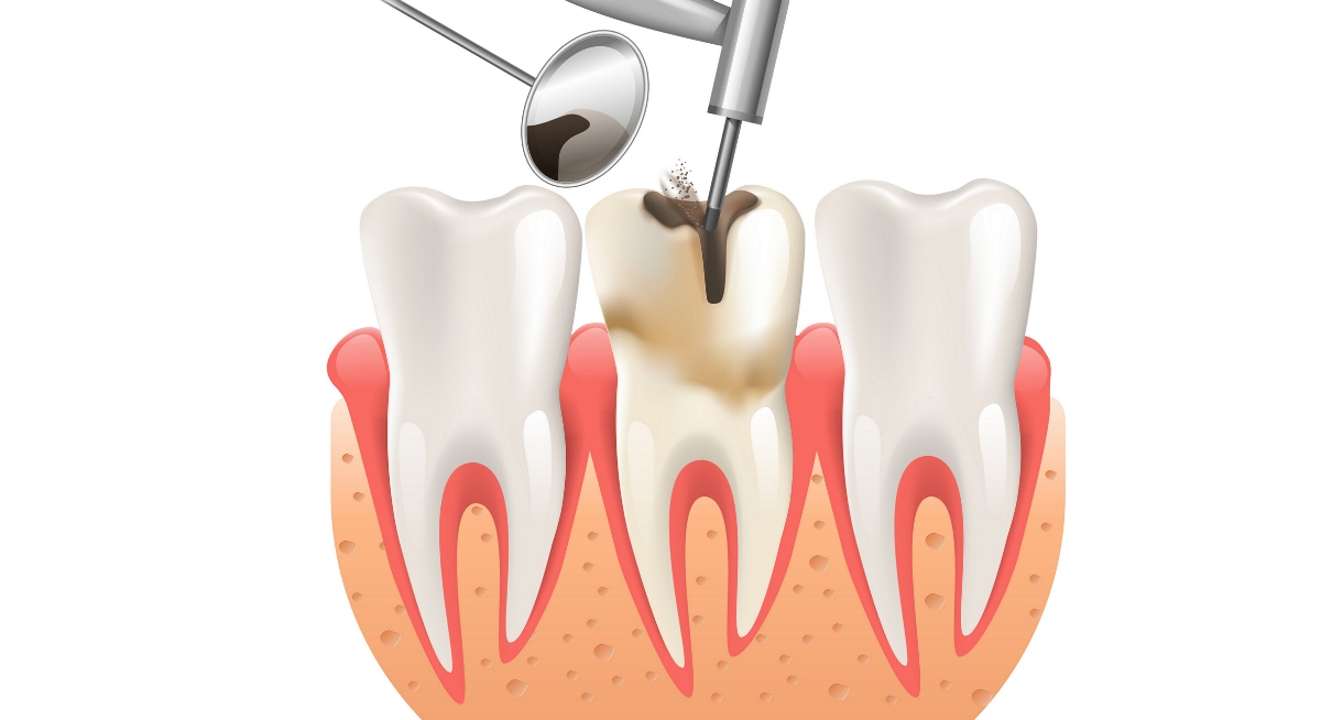علامت اصلی عفونت ریشه دندان