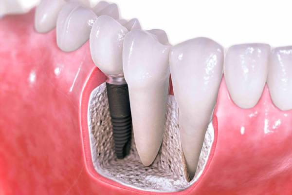 علائم عفونت ایمپلنت دندان1