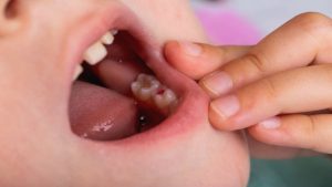 علل پوسیدگی دندان شیری کودکان