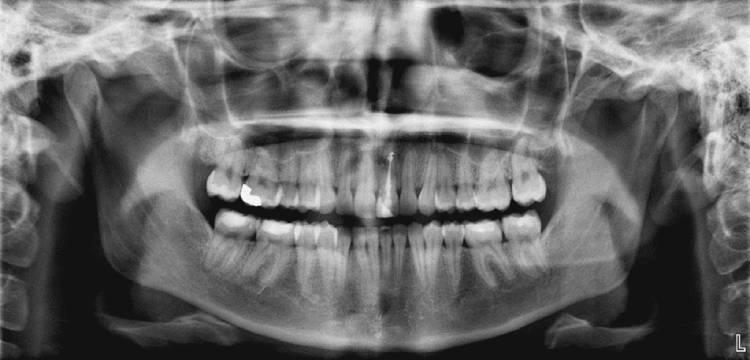 عکس CBCT دندان
