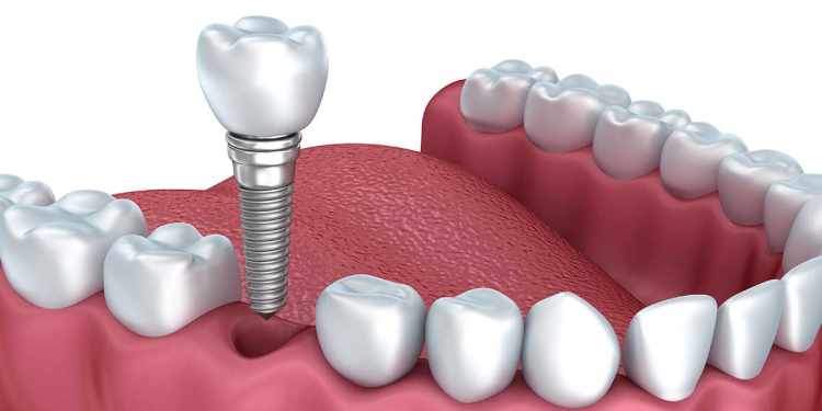 مراقبت‌ های بعد از ایمپلنت دندان