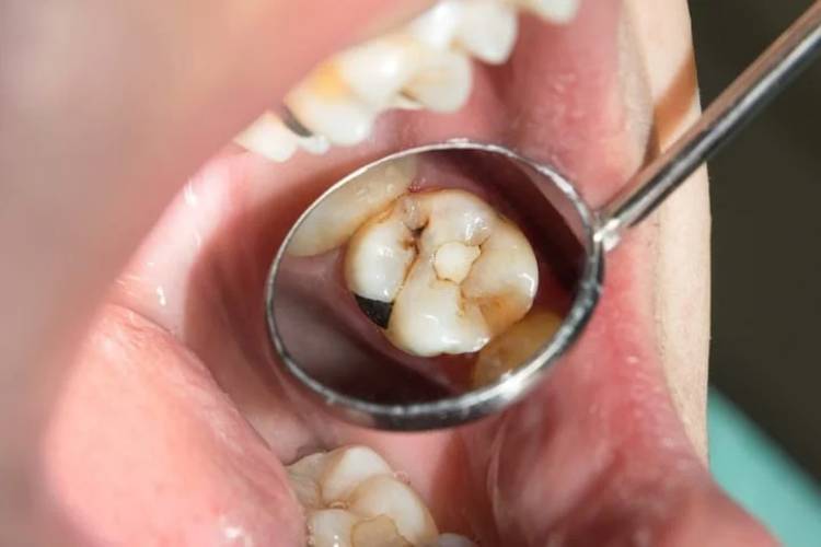 مراقبت‌های بعد از پر کردن دندان