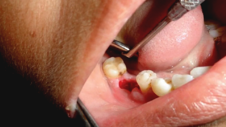 علائم عفونت بعد از کشیدن دندان