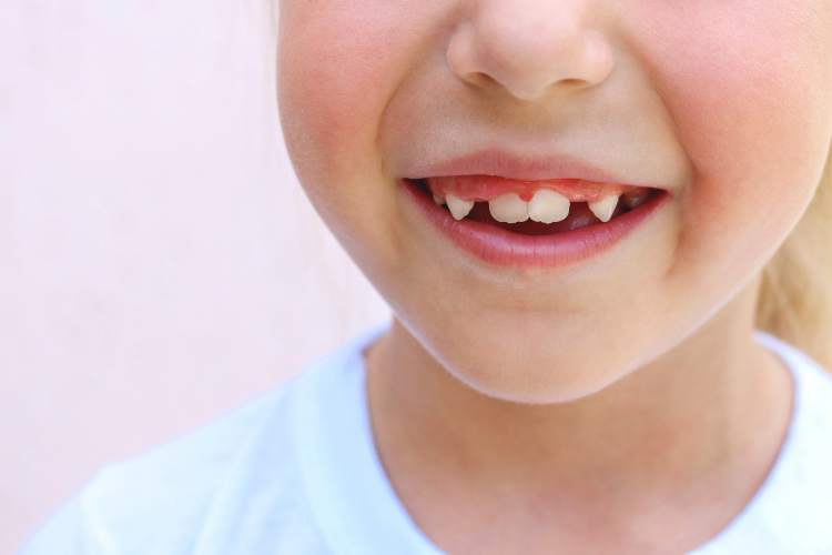 علت کج درآمدن دندان دائمی کودک