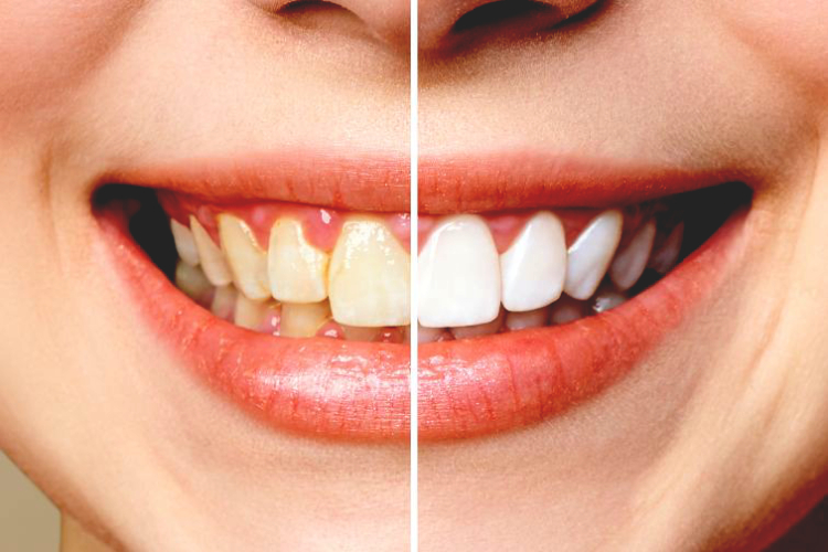 دلایل تغییر رنگ روکش دندان