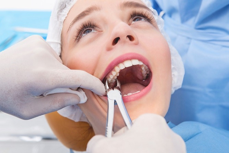 مراقبت‌های بعد از کشیدن دندان عقل