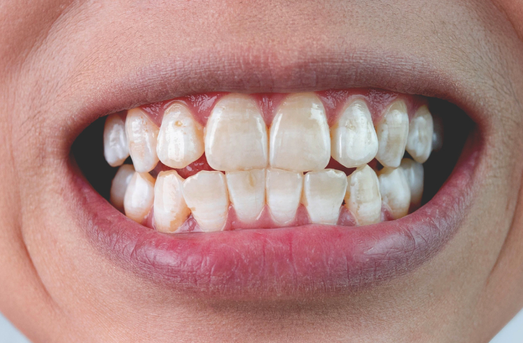 فلوروزیس دندانی