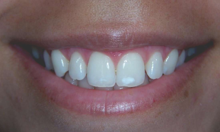فلوروزیس دندانی