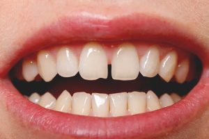 دلایل ایجاد فاصله بین دندانی