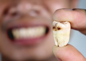 عوامل مؤثر در نکروز دندان